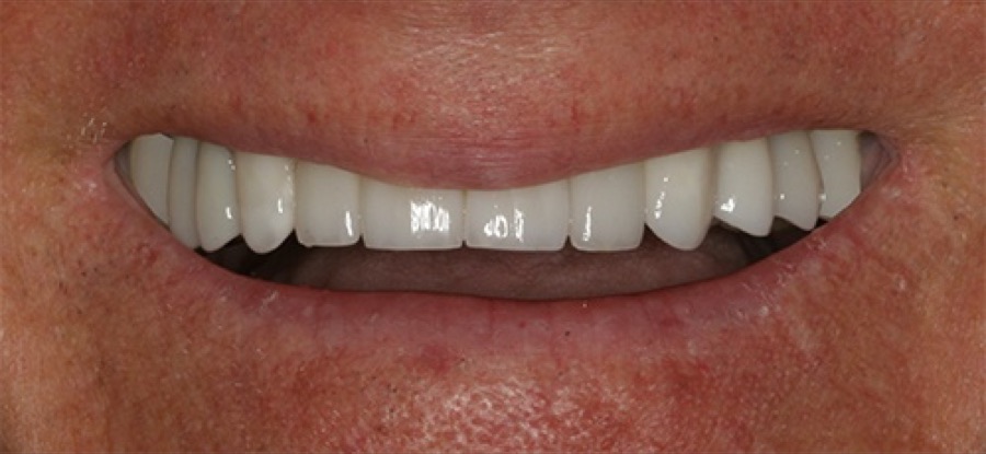 After treatment
