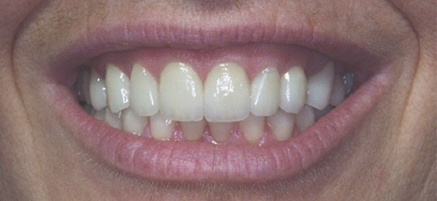 After treatment
