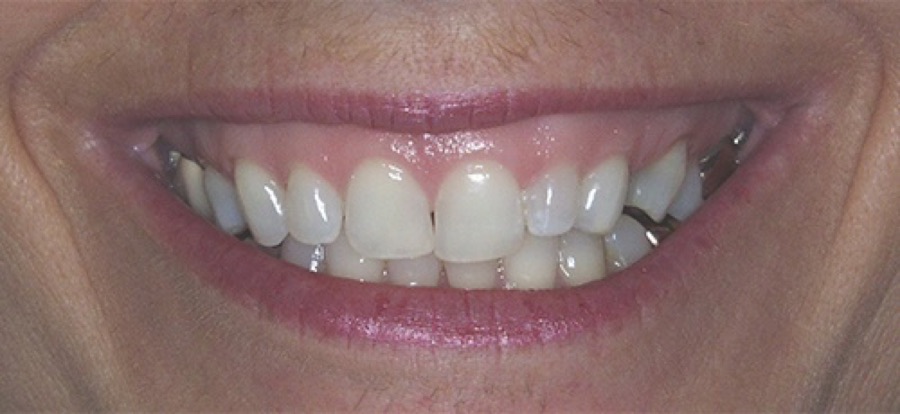 Before treatment
