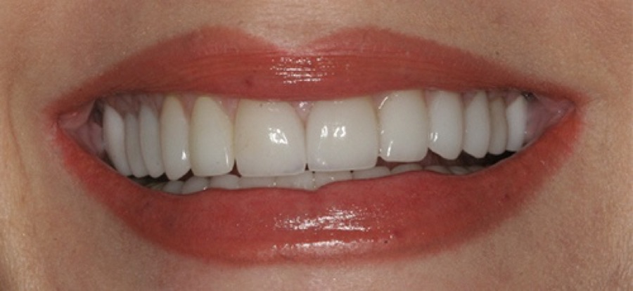 After treatment