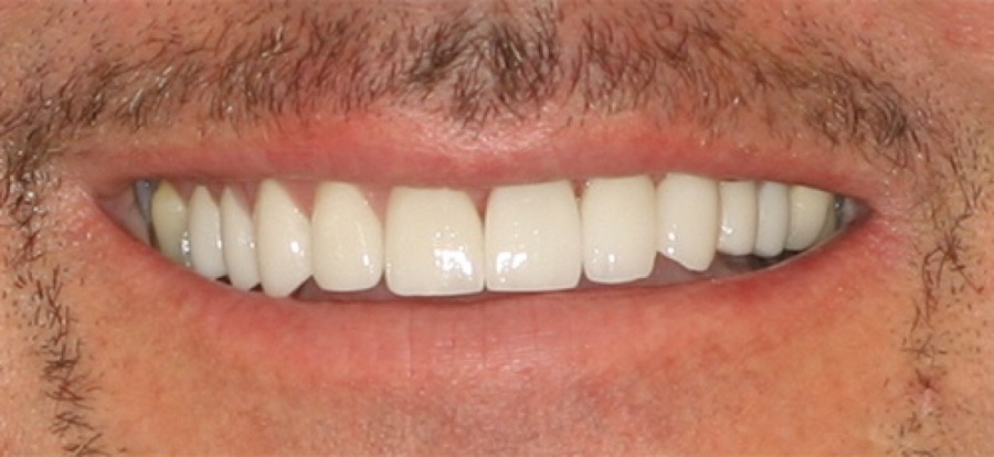 After treatment