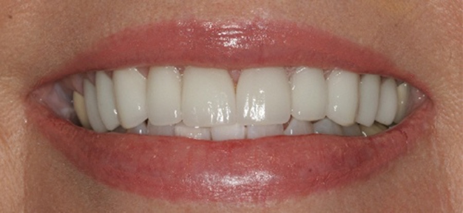 After treatment