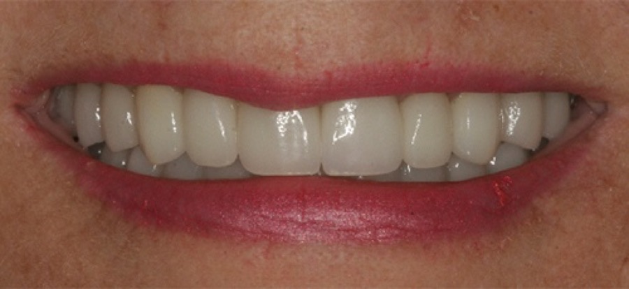 After treatment