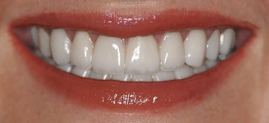 After treatment