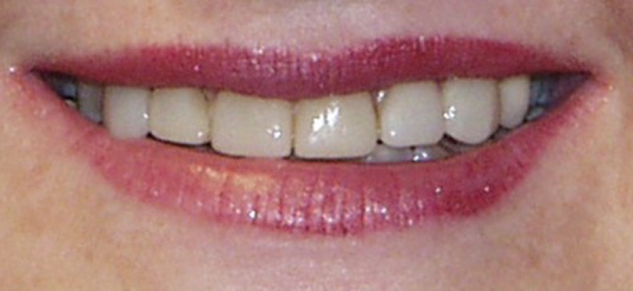 Before treatment