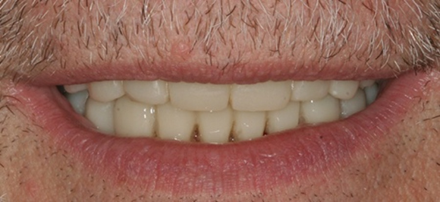 After treatment